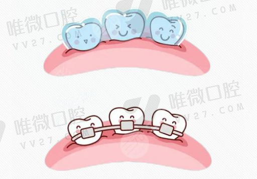 支架手术后多久能种植牙（种牙非常短多久可以完成）(图1)